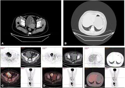 Rare giant ovarian metastasis arising from a small primary lung adenocarcinoma: a case report
